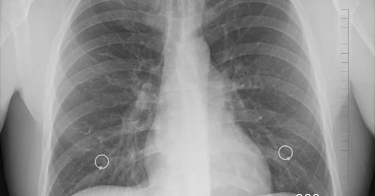 A tuberkulózis (tbc) elleni küzdelem világnapja