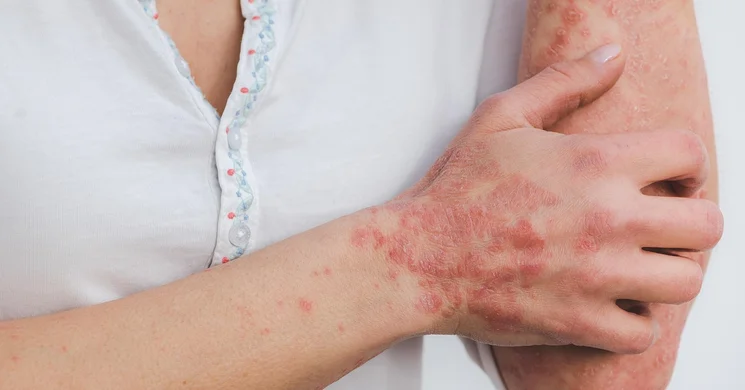 Október 29.A Pikkelysömör (psoriasis) világnapja